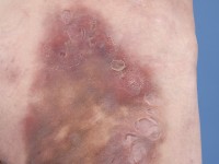 Plaque form hidradenitis suppurativa