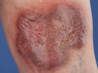 Plaque form hidradenitis suppurativa