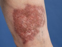 Plaque form hidradenitis suppurativa