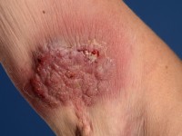 Plaque form hidradenitis suppurativa