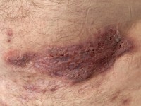 Plaque form hidradenitis suppurativa