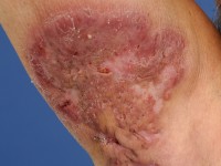 Plaque form hidradenitis suppurativa