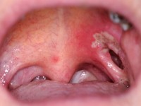 Pyostomatitis vegetans