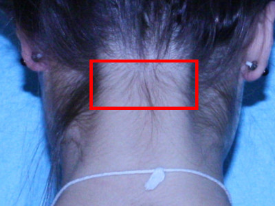 Plek om biopten af te nemen bij verdenking op rabies