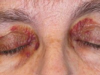 Raccoon eyes bij systemische amyloidose