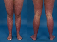 Amoxicilline rash bij EBV