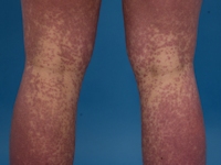 Amoxicilline rash bij EBV