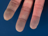 Raynaud's phenomenon