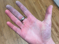 Raynaud's phenomenon