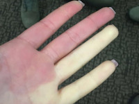 Raynaud's phenomenon