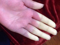 Raynaud's phenomenon