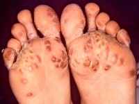 Keratoderma blenorrhagica