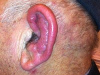 Relapsing polychondritis