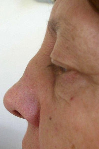 Relapsing polychondritis