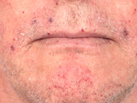 Rendu-Osler-Weber syndroom