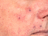 Rendu-Osler-Weber syndroom