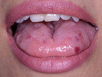 Rendu-Osler-Weber syndroom