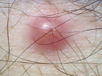 Reticulohistiocytoma