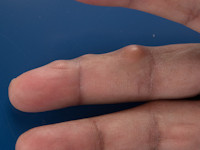 rheuma noduli, reuma knobbels, nodulus rheumaticus