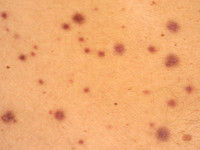 Reuscel angiohistiocytoom