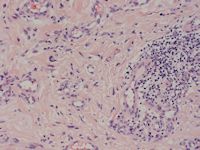 Reuscel angiohistiocytoom