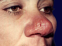 Rhinoscleroma