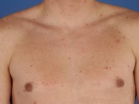 African tick bite fever