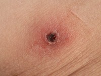 African tick bite fever