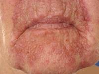 Rosacea papulopustulosa