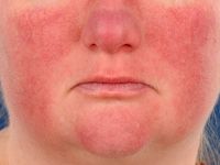 rosacea, erythemateus