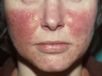 Rosacea