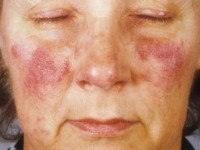 Rosacea