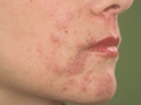 Rosacea