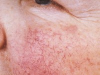 Rosacea