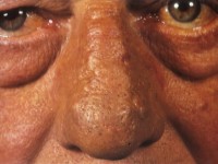 Rosacea with lympedema
