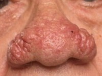 Rosacea, rhinophyma