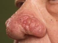 rosacea, rhinophyma