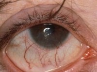 rosacea, keratitis