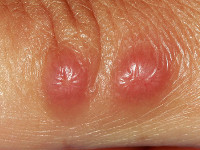 Rosai-Dorfman disease