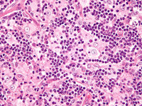 Rosai-Dorfman disease