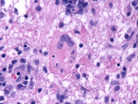 Rosai-Dorfman disease