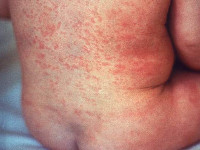 Rode hond (rubella, German measles)