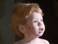 Rode hond (rubella, German measles)