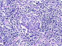 Biopt speekselklier bij het Sjögren syndroom