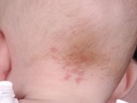 Naevus van Unna, ooievaarsbeet