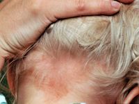 Naevus van Unna, ooievaarsbeet