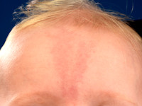 Naevus van Unna, ooievaarsbeet