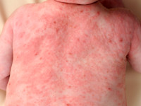 Scabies (schurft)
