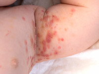 Scabies (schurft)