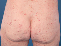 Scabies (schurft)